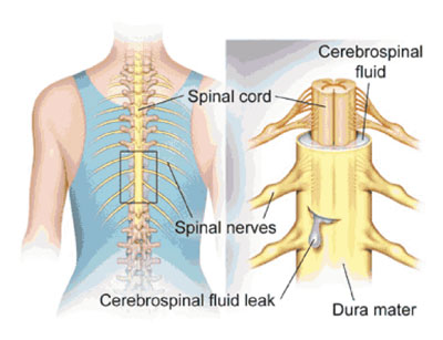 spinal fluid leak after lumbar surgery